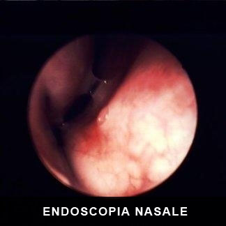 Endoscopia nasale