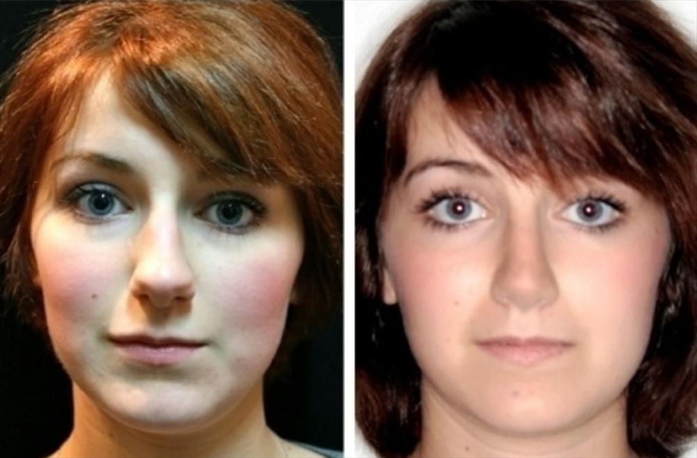 Rinoplastica prima/dopo - Immagine 13