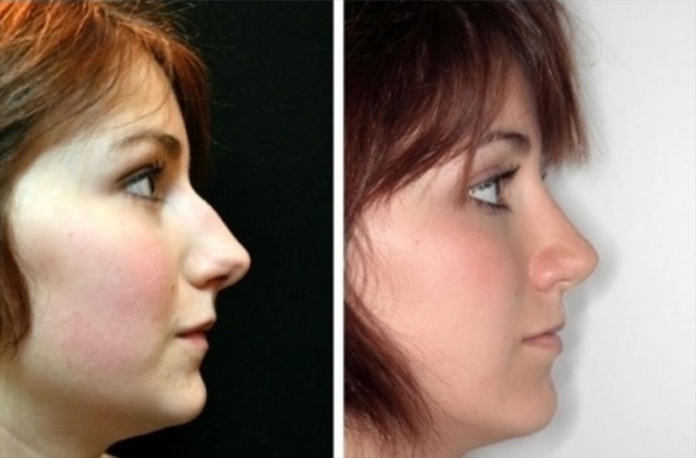 Rinoplastica prima/dopo - Immagine 14