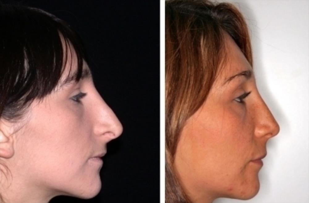 Rinoplastica prima/dopo - Immagine 16