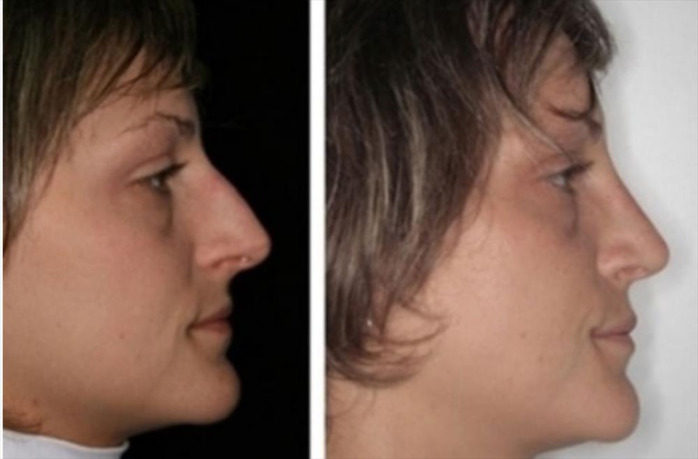 Rinoplastica prima/dopo - Immagine 18
